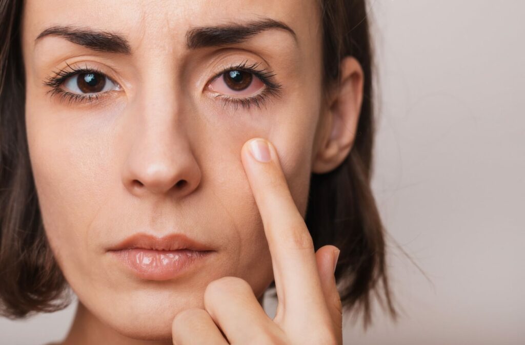 Close-up of a person pointing to redness under her eye, showing irritation or possible eye condition.